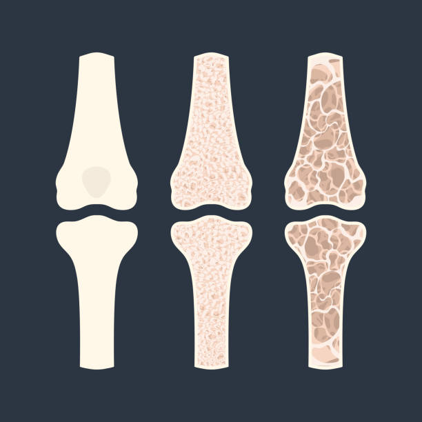 osteoporose knochendichte verlust krankheit medizinische infografiken - osteoporose stock-grafiken, -clipart, -cartoons und -symbole