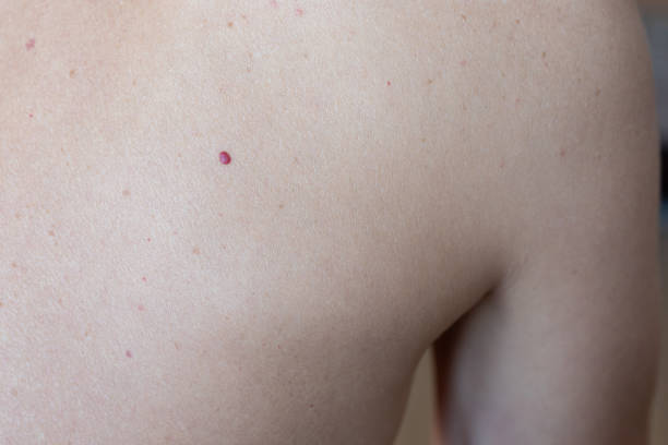 istock angioma. red mole on back. rupture of a capillary vessel. 1269988145