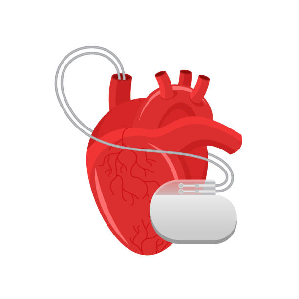 pacemaker - menschliches herz und kardioimplantat - herzschrittmacher stock-grafiken, -clipart, -cartoons und -symbole