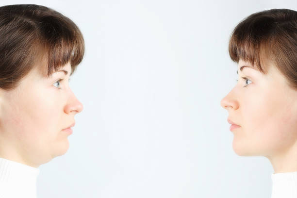 perfil de la cara femenina con y sin una segunda barbilla, concepto antes y después de la cirugía plástica - second skin fotografías e imágenes de stock