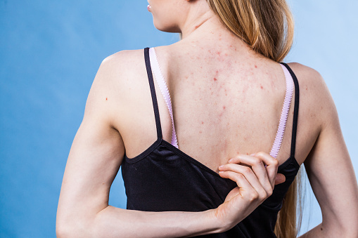 Mujer con problemas de piel acné en la espalda photo