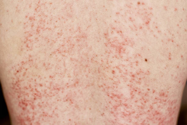 istock Allergic rash on skin. Woman with dermatology problem on back skin 1270060095