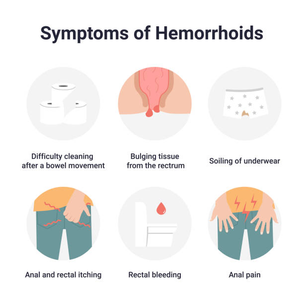 ustawić objawy hemoroidów - hemorrhoid stock illustrations