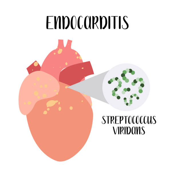 ilustrações, clipart, desenhos animados e ícones de endocardite. inflamação do coração - endocárdio. streptococcus viridans. ilustração de desenho animado vetorial. perfeito para banner, folheto médico, panfleto - endocardite