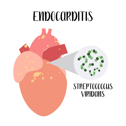 Endocarditis Animation Endocarditis Inflammation Of The Heart Endocardium Streptococcus ...