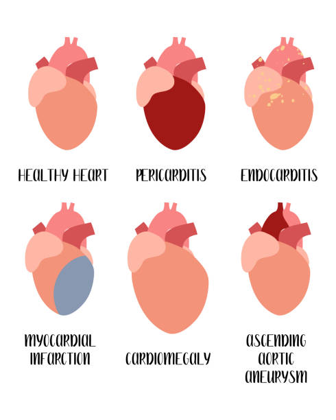 Heart, cardiovascular diseases. Pericarditis, endocarditis, myocardial infarction, cardiomegaly, aneurysm. Cardiology. Vector flat illustration. For flyer, medical brochure, banner, landing page, web Heart, cardiovascular diseases. Pericarditis, endocarditis, myocardial infarction, cardiomegaly, aneurysm. Cardiology. Vector flat illustration, isolated on white. For flyer, medical brochure, banner, landing page, web endocarditis stock illustrations