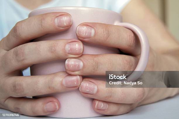 カルシウムの欠損やストレスによる爪に多くの白い斑点マグカップを持つ女性の手 - 手の爪のストックフォトや画像を多数ご用意 - 手の爪, 白色, 不足