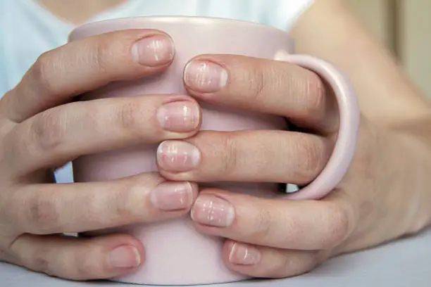 Photo of Many white spots on fingernails (Leukonychia) due to calcium deficit or stress. Female hands holding mug