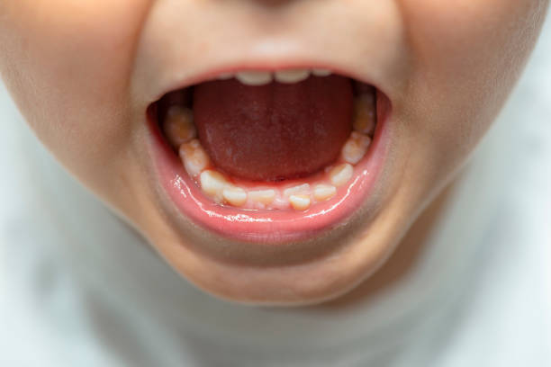 istock A little boy with an open mouth showing milk teeth and constantly growing teeth. 1270316151