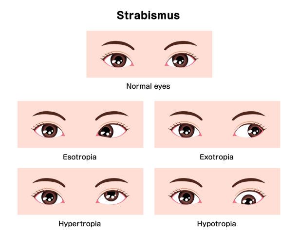 типы иллюстрации вектора косоглазия - cross eyed stock illustrations