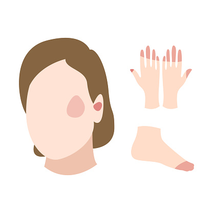 Face, hand and foot with frostbite symptoms, allergy or skin burn. Skin redness, erythema, hypothermia. Flat vector illustration, isolated on white