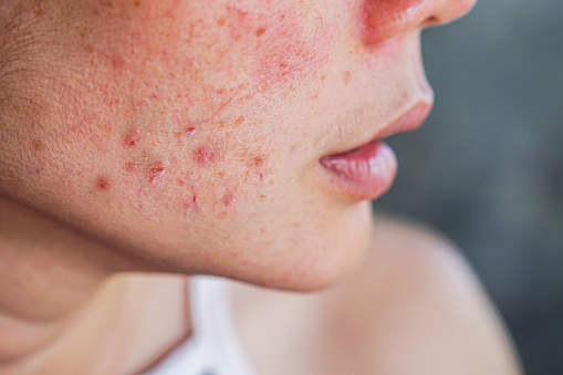 acné en la cara de la mujer con la piel de erupción, cicatrices y manchas que alérgicos a los cosméticos photo