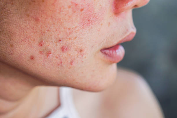 発疹肌、傷、化粧品にアレルギーのあるスポットで女性の顔ににきび - にきび ストックフォトと画像