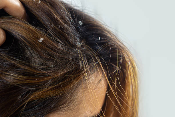 Closeup Hair With Dandruff Scalpseborrheic Dermatitis Stock Photo - Download Image Now - iStock Closeup Hair With Dandruff Scalpseborrheic Dermatitis Stock Photo - Download Image Now - iStock