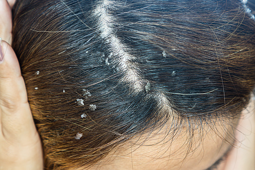 pelo de primer plano con cuero cabelludo de la caspa, dermatitis seborreica photo