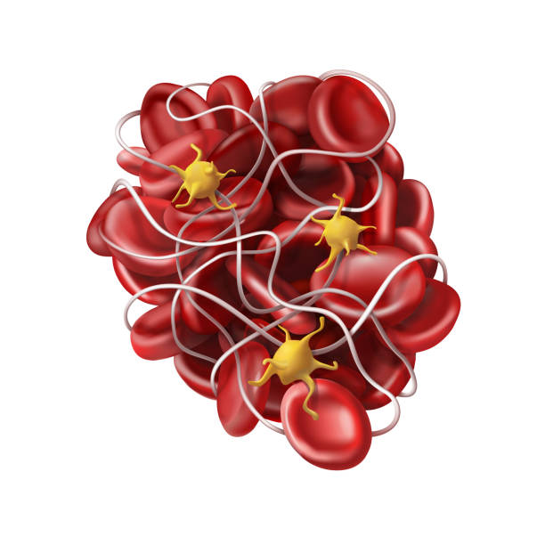 4,194 Blood Clot Illustrations & Clip Art - iStock | Blood cells, Pulmonary  embolism, Blood