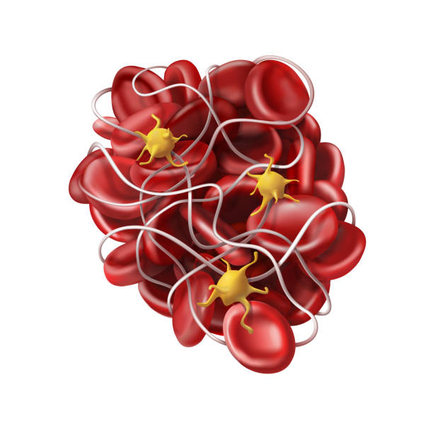 Medicine. A blood clot or thrombus - coagulation. 3d vector illustration Medicine. A blood clot or thrombus - coagulation. 3d vector illustration blood clot stock illustrations