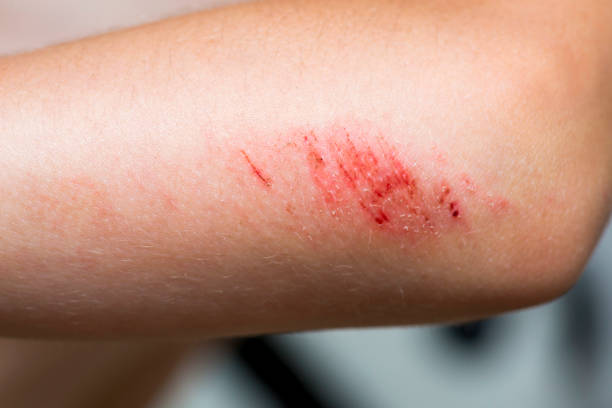 Children injury. Deep scratches on the skin on the kids elbow hand. Wounds, scratches, abrasions on the child arm. Children injury. Deep scratches on the skin on the kids elbow hand. Wounds, scratches, abrasions on the child arm. wounded stock pictures, royalty-free photos & images