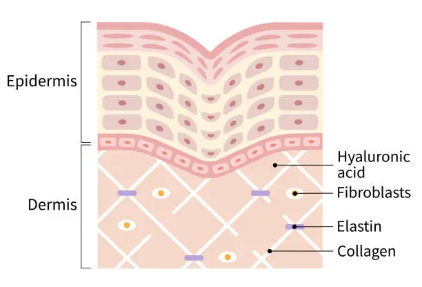 Vector illustration of diagram of winkle skin. the collagen framework is broken and wrinkles appears. Beauty skin care concept