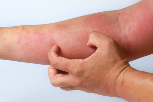 istock Eczema allergy skin, atopic dermatitis. 1270931025