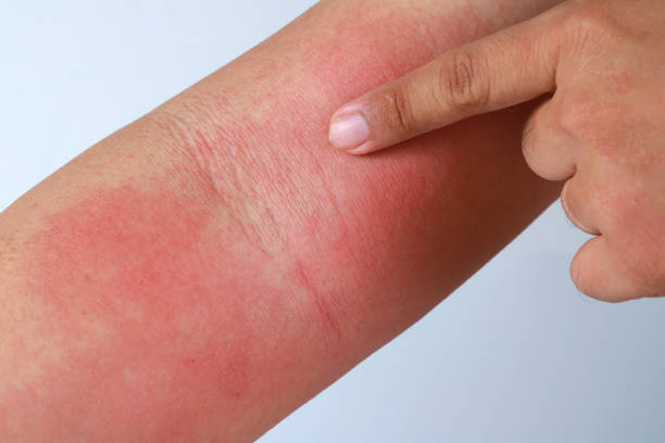 istock Eczema allergy skin, atopic dermatitis. 1270932823