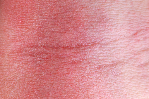 Full frame image of atopic eczema allergy texture of a patient skin