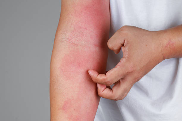 Eczema allergy skin, atopic dermatitis. A close-up of bad psoriasis on a person's arm scratching stock pictures, royalty-free photos & images