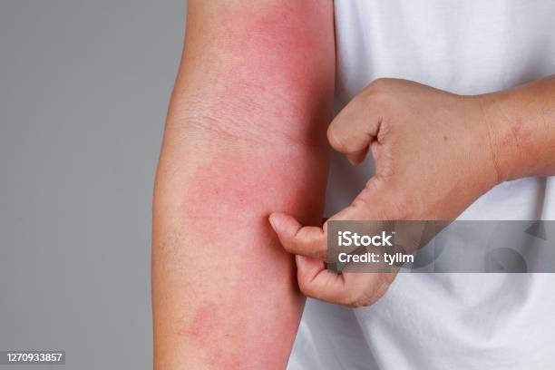 Eczema Allergy Skin Atopic Dermatitis Stock Photo - Download Image Now - Skin, Eczema, Skin Condition