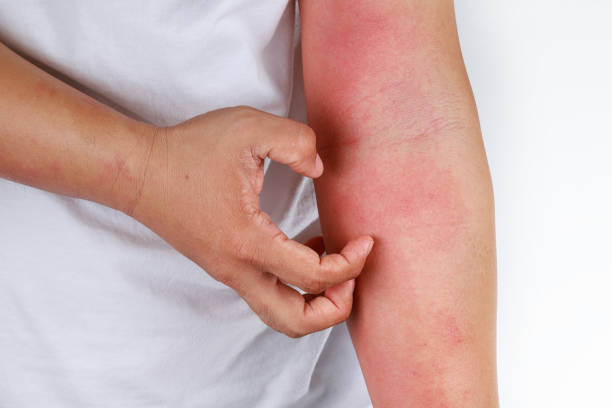 istock Eczema allergy skin, dermatologic diseases. 1270933861