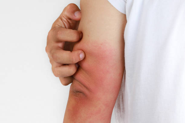 istock Eczema allergy skin, dermatologic diseases. 1270937390