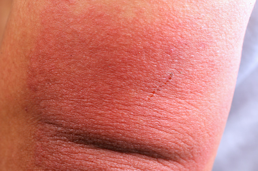 Atopic eczema allergy texture of a patient skin