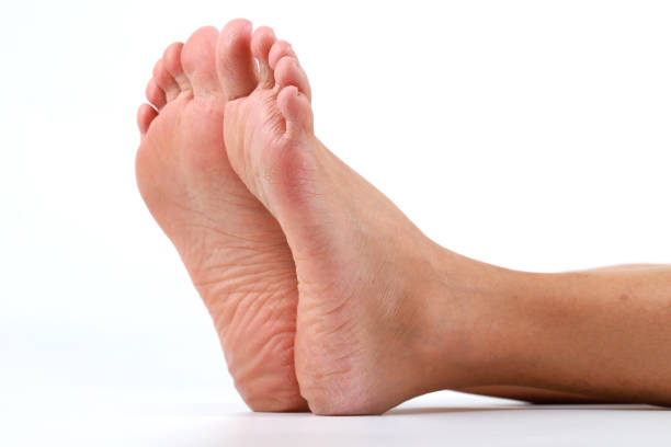 istock Dry and cracked woman's heel on white background 1270949618