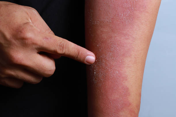 istock Dermatitis eczema texture of ill human skin 1270950720
