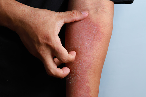 Dermatitis eczema textura de mala piel humana photo