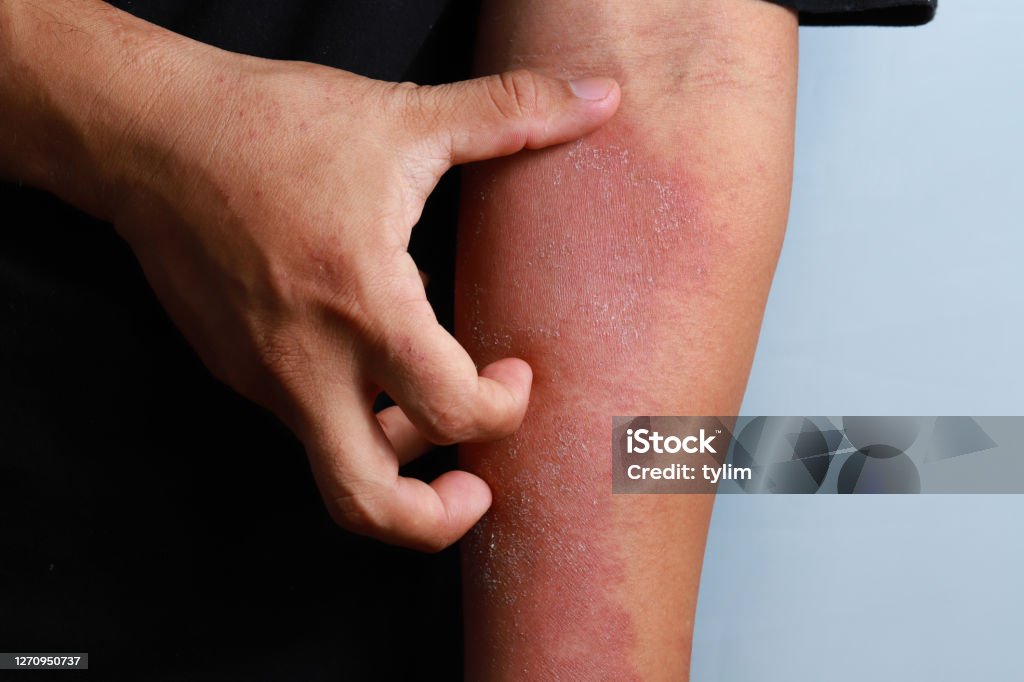 Dermatitis eczema texture of ill human skin Man scratching his arm, medical atopic eczema allergy texture of ill human skin Eczema Stock Photo