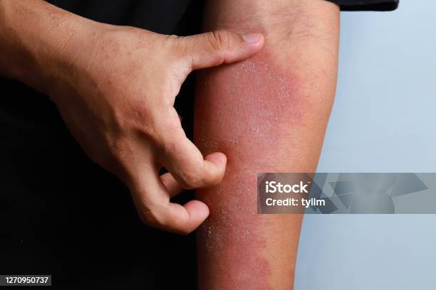 Dermatitis Eczema Texture Of Ill Human Skin Stock Photo - Download Image Now - Eczema, Atopic Eczema, Psoriasis