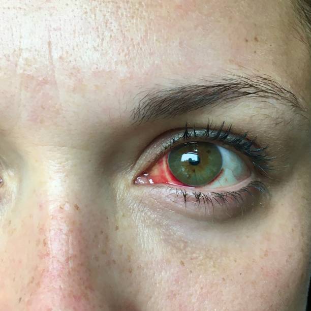 istock Broken Blood Vessel in Eye 1270977545