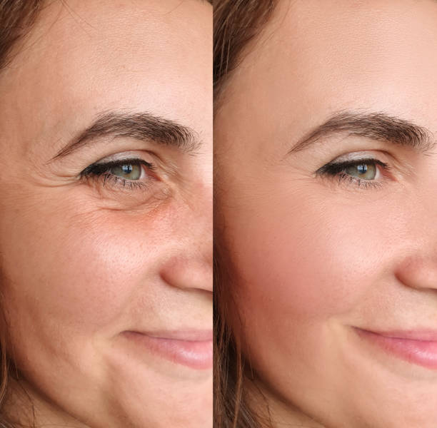 donna faccia rughe prima e dopo il trattamento collage - wrinkled foto e immagini stock
