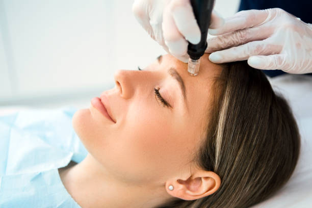 дермапен кожи needling лечения - beauty treatment стоковые фото и изображения