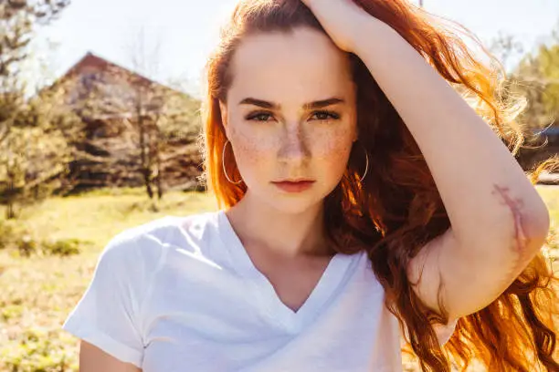 Close up portrait of young gorgeous caucasian ginger woman with freckles outside. Large scar on the elbow, natural concept.
