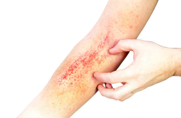 Atopic dermatitis (AD), also known as atopic eczema, is a type of inflammation of the skin (dermatitis) at hands stock photo Atopic dermatitis (AD), also known as atopic eczema, is a type of inflammation of the skin (dermatitis) at hands stock photo skin inflammation stock pictures, royalty-free photos & images