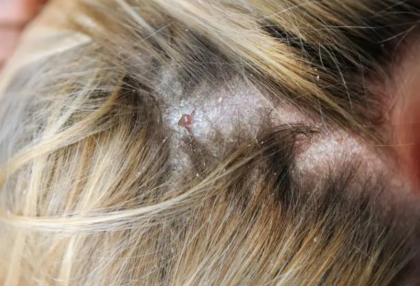 Dandruff in the hair and scalp.Dandruff, dermatitis on the head of a girl. Seborrheic lichen.