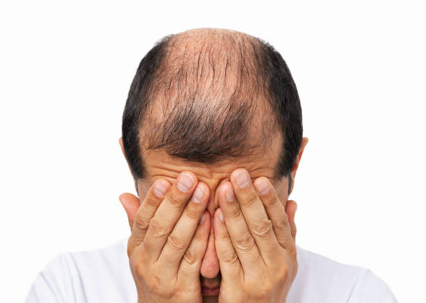 hombre calvo estresado por la pérdida rápida de cabello - irradiation fotografías e imágenes de stock