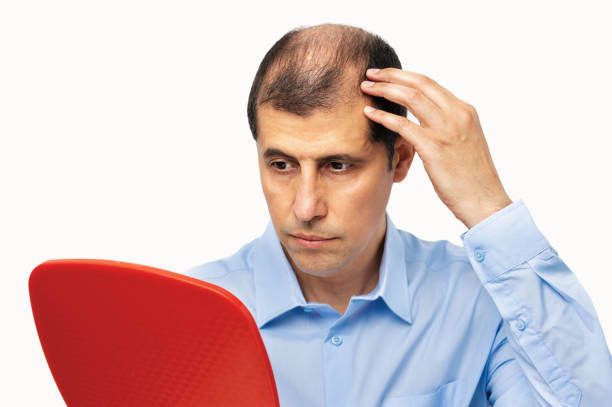istock upset middle aged man with alopecia 1271091986