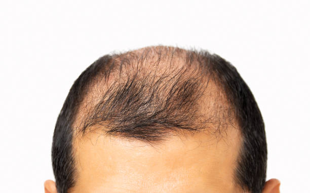 istock Hair loss concept 1271092043