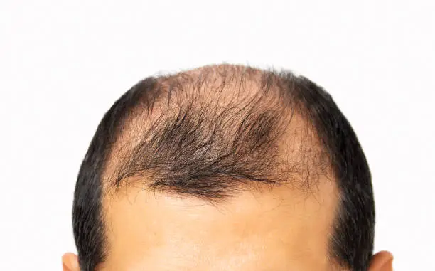 Photo of Hair loss concept