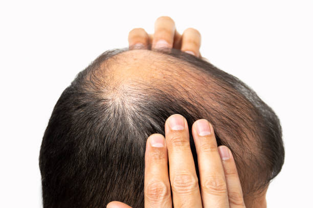 istock Middle-aged man concerned with hair loss 1271092072