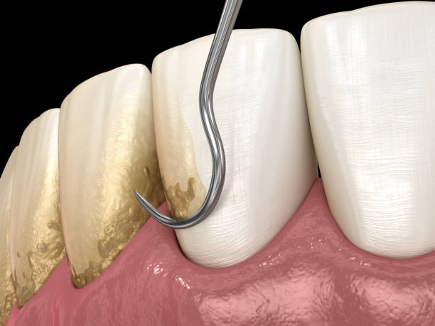 istock Oral hygiene: Scaling and root planing (conventional periodontal therapy). Medically accurate 3D illustration of human teeth treatment 1271122652