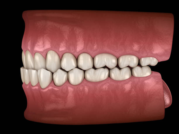 istock Underbite dental occlusion ( Malocclusion of teeth ). Medically accurate tooth 3D illustration 1271122666
