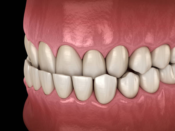 unterbiß dental okklusion (malokklusion der zähne). medizinisch genaue zahn 3d-illustration - fehlbiss stock-fotos und bilder